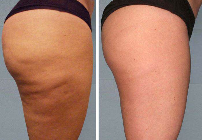 What you should drink if you want to expel belly fat and cellulite naturally and quickly