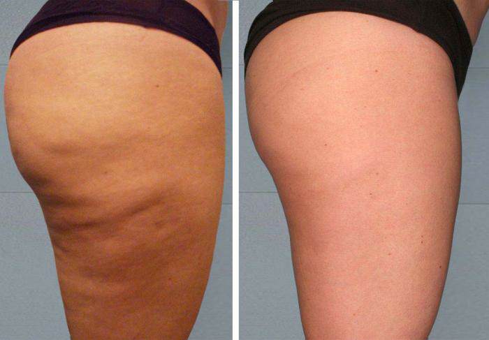 Que vous devriez boire si vous voulez expulser la graisse du ventre et la cellulite naturellement et rapidement