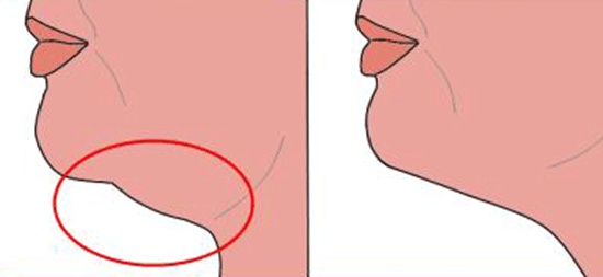 Exercices pour le double menton – Apprenez comment perdre votre double menton sans liposuccion du menton